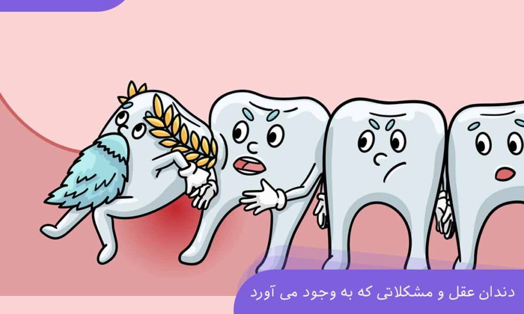 Wisdom tooth0
